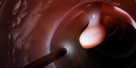 Endoscopist's Performance, Not High-Risk Polyps, Influences CRC Risk in the First Years After a Colonoscopy